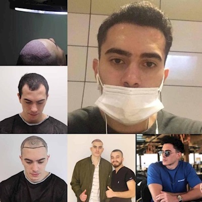 Saç Ekimi Sonrası Nelere Dikkat Etmelisiniz?