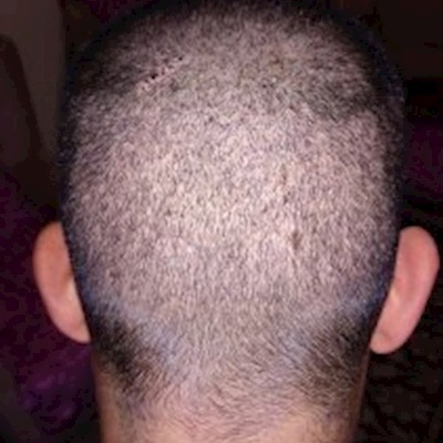  Köklerin Alındığı Donör Bölgede Saçlar Tekrar Çıkar mı?